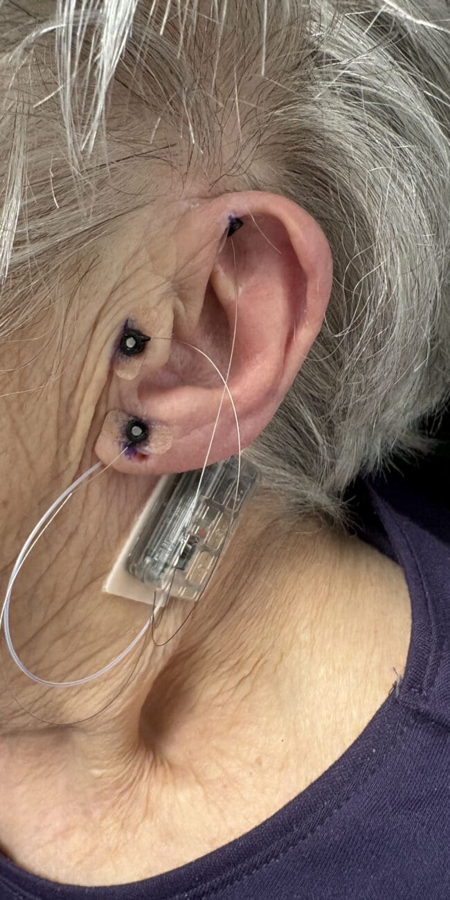 Patient Wearing The Vagal Nerve Stimulator Device for Diabetic Neuropathy Pain | Diabetic Nerve Clinic